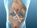 ACL Reconstruction (Patellar Tendon Graft Technique)