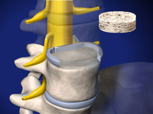 ALIF: Anterior Lumbar Interbody Fusion (with bone graft and pedicle screws) video thumbnail