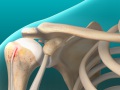 Biceps Tendon Rupture