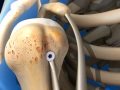 Biceps Tenodesis