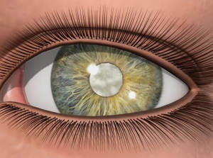 Cataracts educational video provided by Eye Care and Vision Associates, Ophthalmology, Buffalo, NY