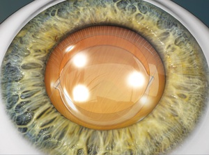 Cataract Removal (Phacoemulsification Method) educational video provided by Eye Care and Vision Associates, Ophthalmology, Buffalo, NY