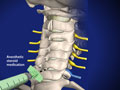 Cervical Epidural Steroid Injection (without contrast)