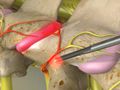 Cervical Facet Radiofrequency Neurotomy