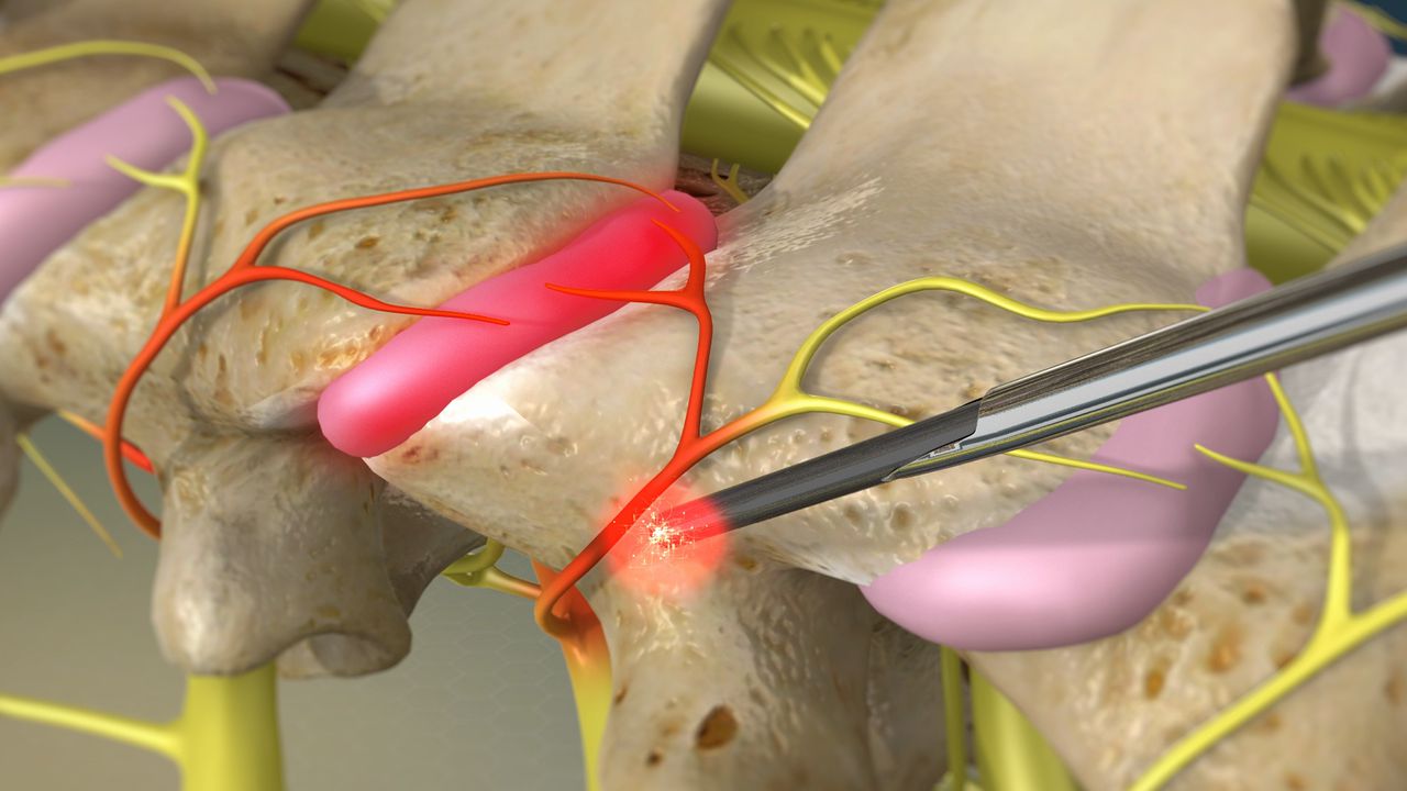 Cervical Facet Radiofrequency Neurotomy