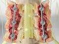Laminectomy (Cervical Spine, With Fusion)