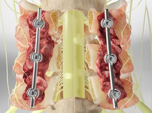Laminectomy (Cervical Spine, With Fusion) video thumbnail
