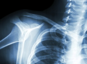 Educational video for Athletic Injuries at Neck, Back, Arm, Leg and Headache Pain Relief Clinic of Marin in San Rafael