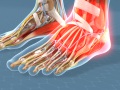 Chronic Lateral Ankle Pain