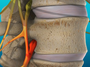 Educational video for Vertebral Subluxation at Neck, Back, Arm, Leg and Headache Pain Relief Clinic of Marin in San Rafael