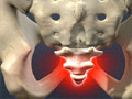 Coccydynia