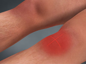 Cold Laser Therapy