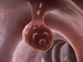 Colorectal Cancer