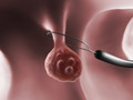 Colon Polypectomy