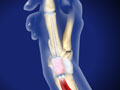De Quervain's Tenosynovitis