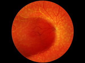 Diabetic Retinopathy educational video provided by Eye Care and Vision Associates, Ophthalmology, Buffalo, NY