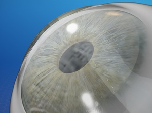 Sutureless Corneal Transplant (DSAEK) educational video provided by Eye Care and Vision Associates, Ophthalmology, Buffalo, NY