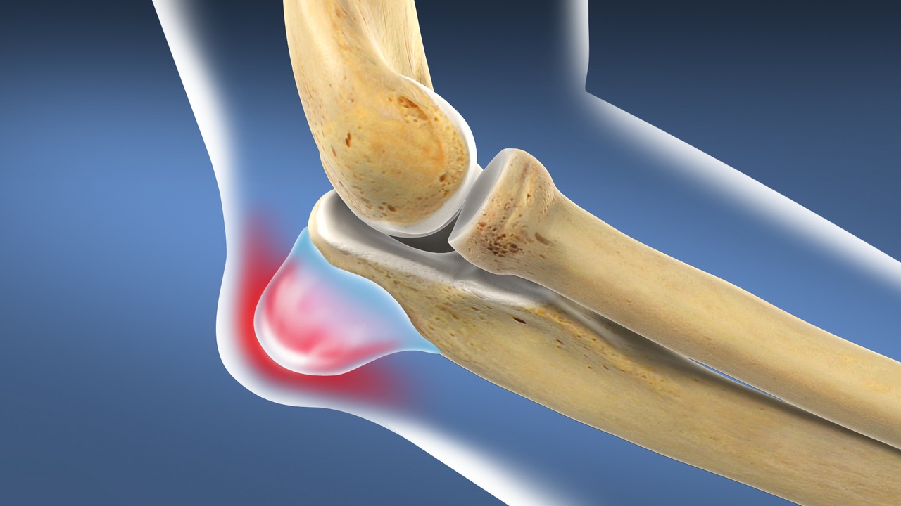 Бурсит локтевого отростка