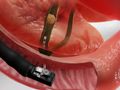 Endoscopic Retrograde Cholangiopancreatogram (ERCP)