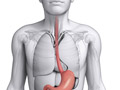 Esophageal Cancer