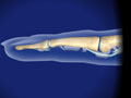 Flexor Tendon Injuries