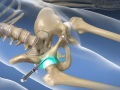 Fluoroscopic Guided Hip Injection