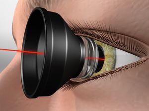 Laser Photocoagulation educational video provided by Eye Care and Vision Associates, Ophthalmology, Buffalo, NY