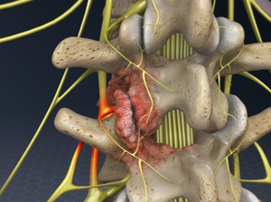 Foraminotomy (Lumbar Spine) video thumbnail