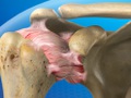 Frozen Shoulder (Adhesive Capsulitis)