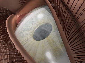 Fuchs' Dystrophy educational video provided by Eye Care and Vision Associates, Ophthalmology, Buffalo, NY