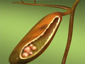 Gallstones