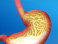 Gastroesophageal Reflux Disease (GERD)