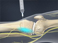 Genicular Nerve Block (G Block)