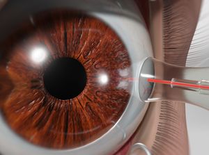 Laser Cyclophotocoagulation (CPC) for Glaucoma educational video provided by Eye Care and Vision Associates, Ophthalmology, Buffalo, NY