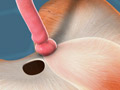 Hiatal Hernia