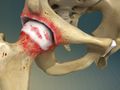 Osteoarthritis of the Hip