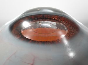 Implantable Collamer Lenses (ICLs)educational video provided by Eye Care and Vision Associates, Ophthalmology, Buffalo, NY
