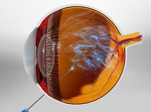 Intravitreal Injection educational video provided by Eye Care and Vision Associates, Ophthalmology, Buffalo, NY