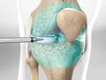 Steroid Injection for Knee Pain (Fluoroscopic-Guided Method)