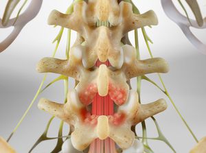 Laminotomy (of the Lumbar Spine) video thumbnail
