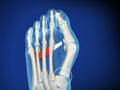 Lapidus Procedure for Bunion Correction