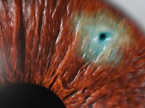 Laser Peripheral Iridotomy (LPI) educational video provided by Eye Care and Vision Associates, Ophthalmology, Buffalo, NY