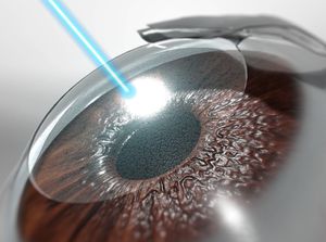 LASIK Eye Surgery educational video provided by Eye Care and Vision Associates, Ophthalmology, Buffalo, NY