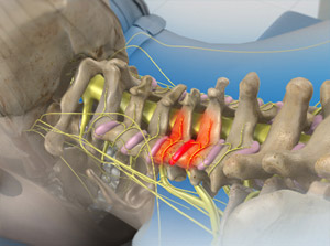 Medial Branch Block (Cervical)