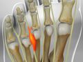 Morton's Neuroma