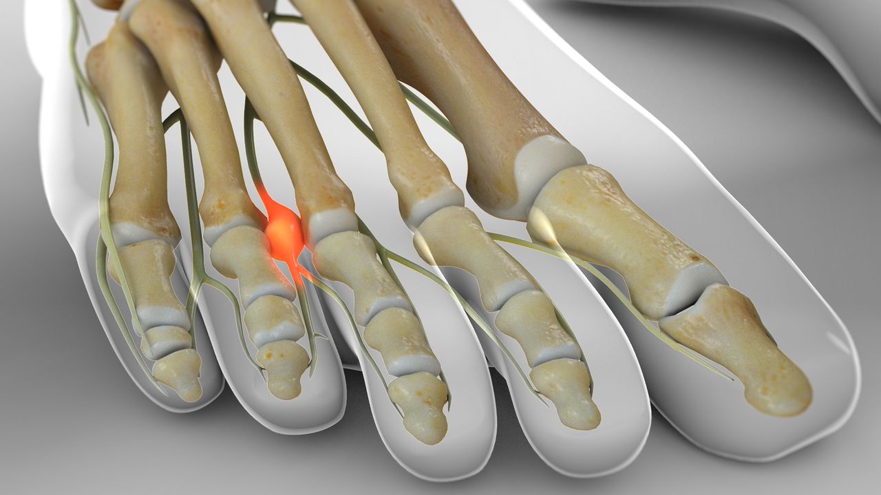 Cuanto cuesta una operación de neuroma de morton