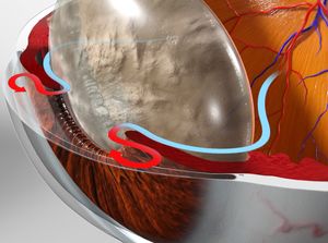 Glaucoma (Angle Closure Type) educational video provided by Eye Care and Vision Associates, Ophthalmology, Buffalo, NY