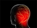 Occipital Neuralgia (Arnold’s Neuralgia)