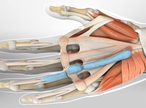 OSS Health | Limited Palmar Fasciectomy for Dupuytren’s Contracture