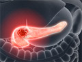Pancreatic Cancer